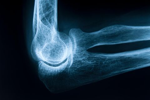 Osteoporose: Ein menschliches  Ellbogengelenk