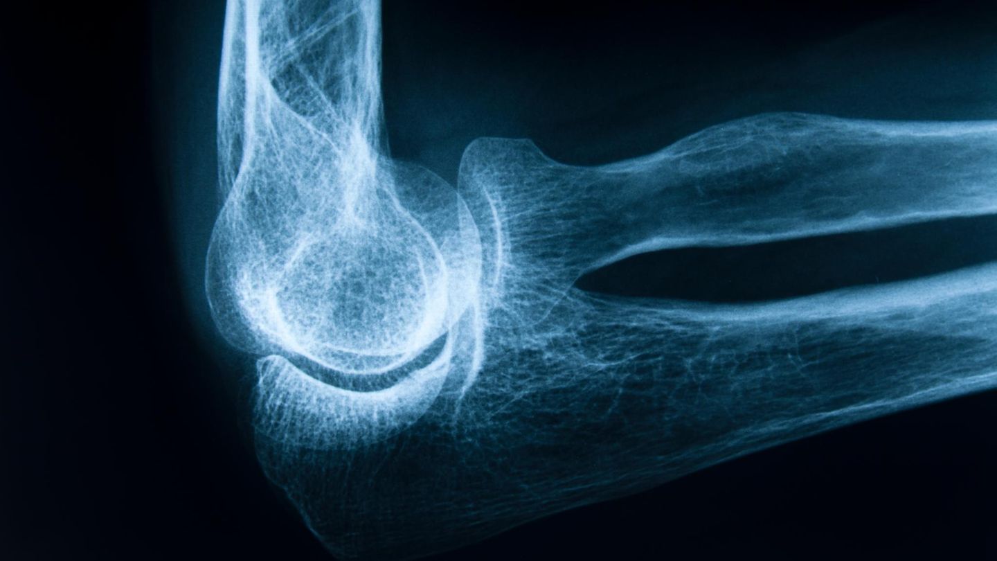 Osteoporose: Ein menschliches Ellbogengelenk Osteoporose: Ein menschliches Ellbogengelenk