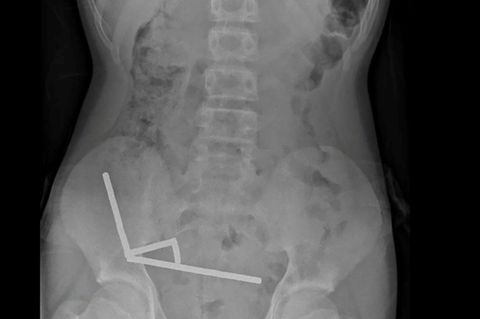Röntgenbild zeigt die Magneten im Unterleib des 13-Jährigen