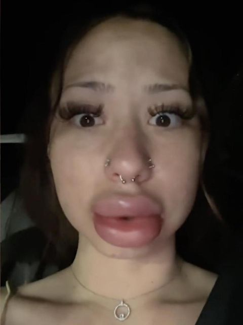 Lippen von US-Bürgerin schwillen irrational an – Schuld ist wohl ein Kuss Lippen von US-Bürgerin schwillen irrational an – Schuld ist wohl ein Kuss