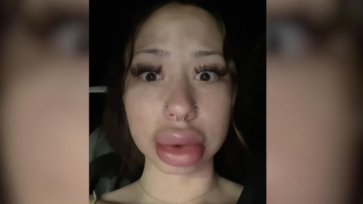 US citizen's lips suddenly swell - | a kiss is probably to blame