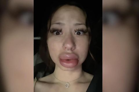 Lippen von US-Bürgerin schwillen irrational an – Schuld ist wohl ein Kuss Lippen von US-Bürgerin schwillen irrational an – Schuld ist wohl ein Kuss