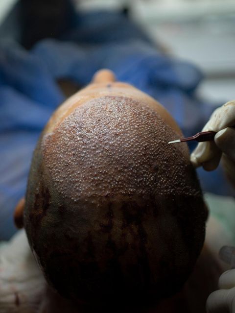 Haartransplantation: So wird es gemacht