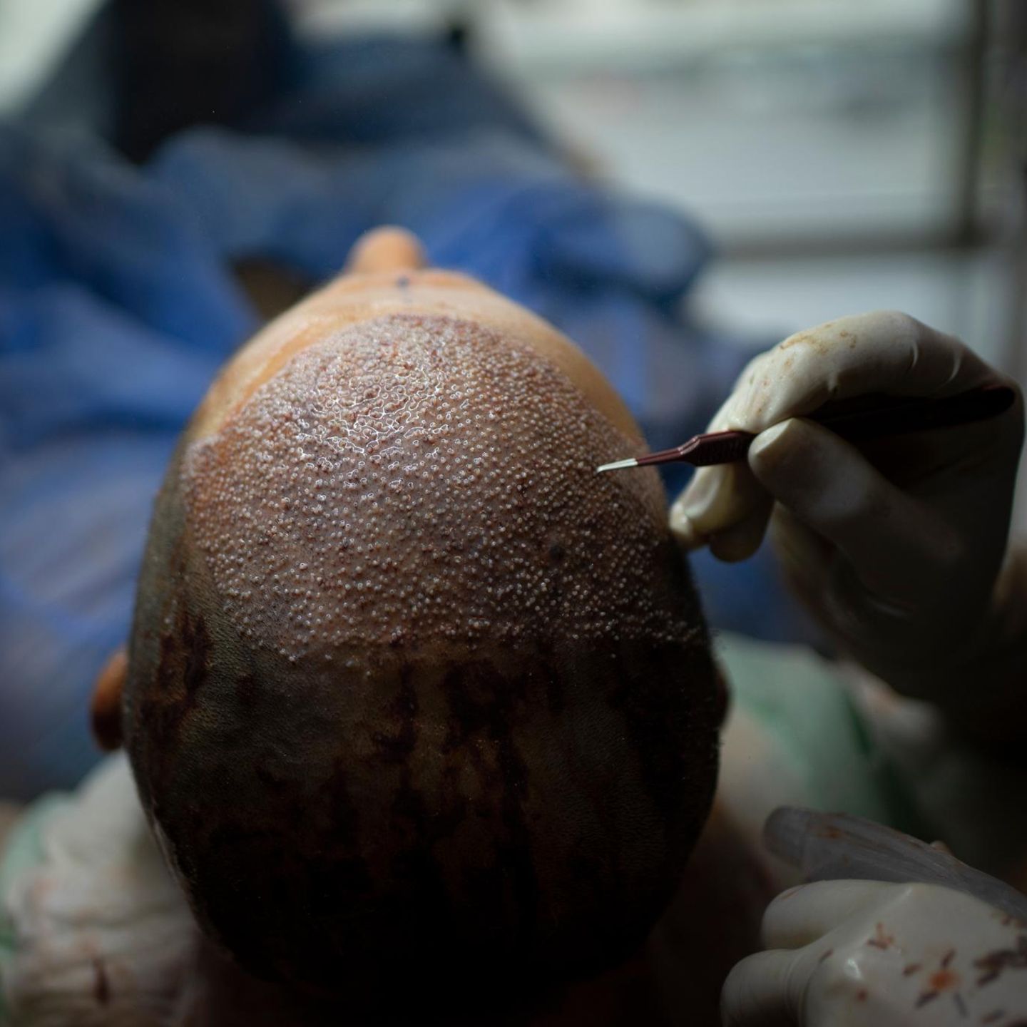 Haartransplantation: So wird es gemacht