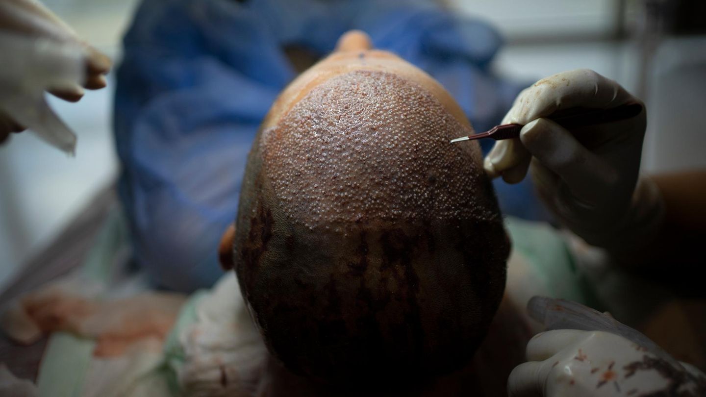 Haartransplantation: So wird es gemacht