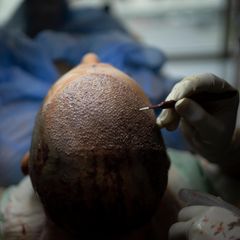 Haartransplantation: So wird es gemacht