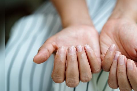 Brüchige Nägel haben meist einen Grund.