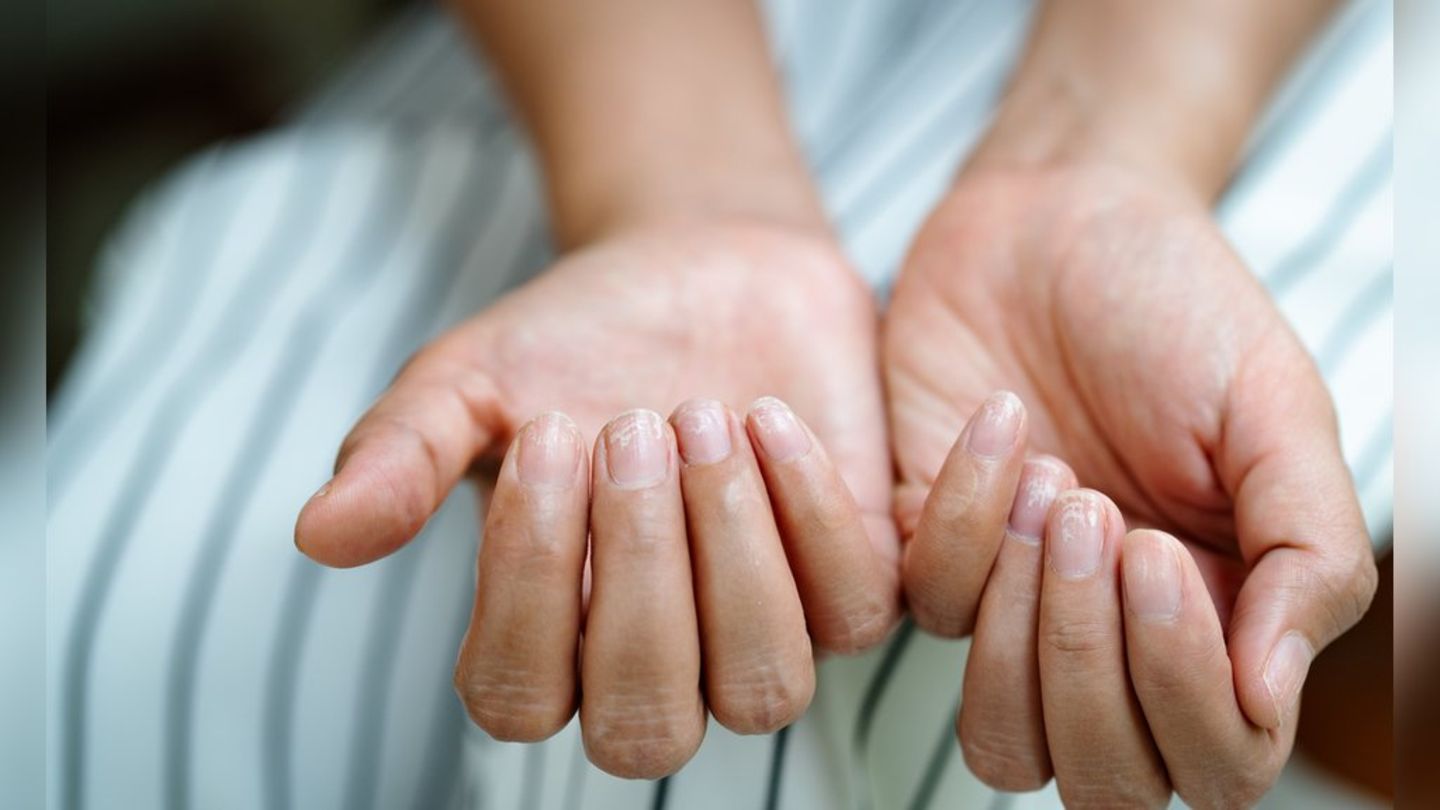 Pflege und Ernährung: So stärkt man brüchige Nägel langfristig