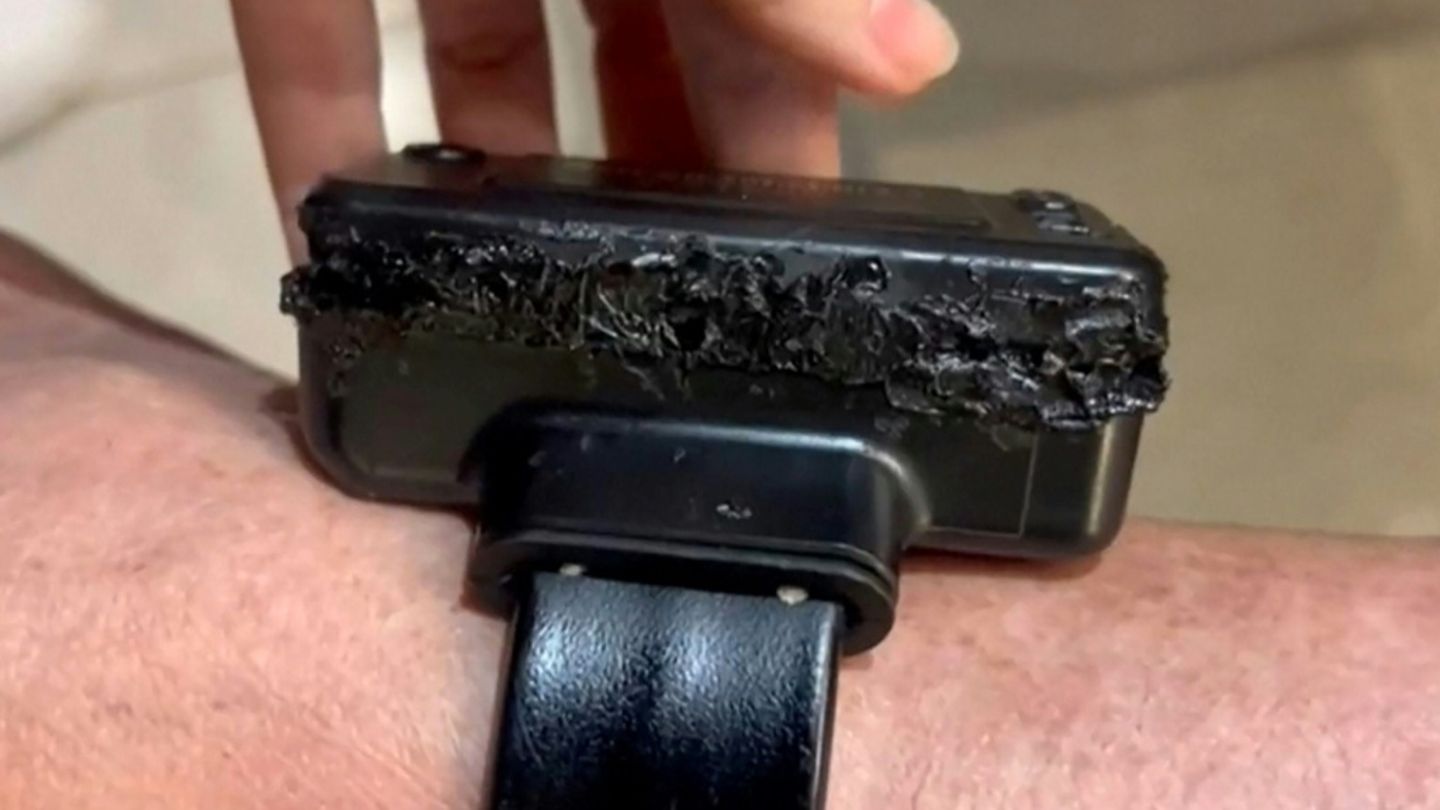 Angeschmorte Fußfessel