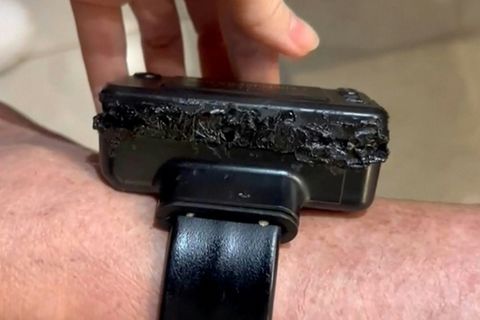 Angeschmorte Fußfessel