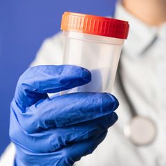 Mensch mit Arztkittel und Handschuhen hält einen Probenbecher. Symbolbild Sperma-Spende