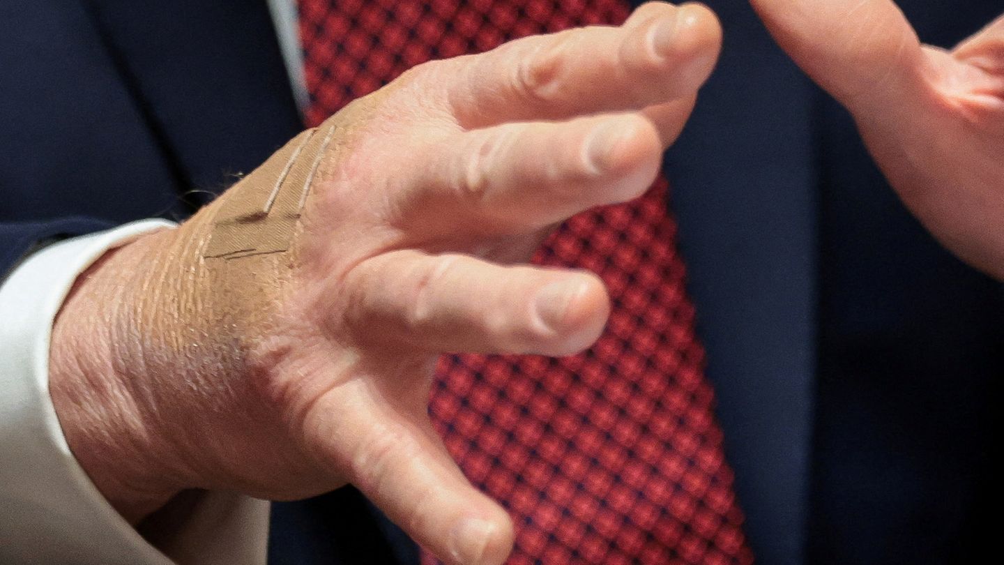 Nahaufnahme von Donald Trumps rechter Hand mit einem Pflaster auf dem Handrücken