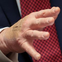Nahaufnahme von Donald Trumps rechter Hand mit einem Pflaster auf dem Handrücken