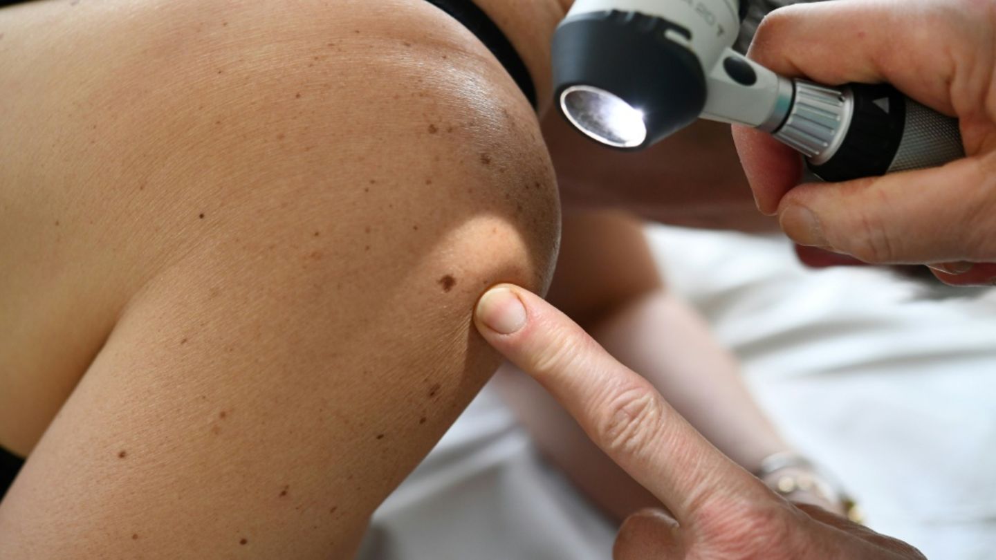 RKI-Etwa-517-800-Menschen-erhielten-2023-Krebsdiagnose-Sterblichkeit-r-ckl-ufig