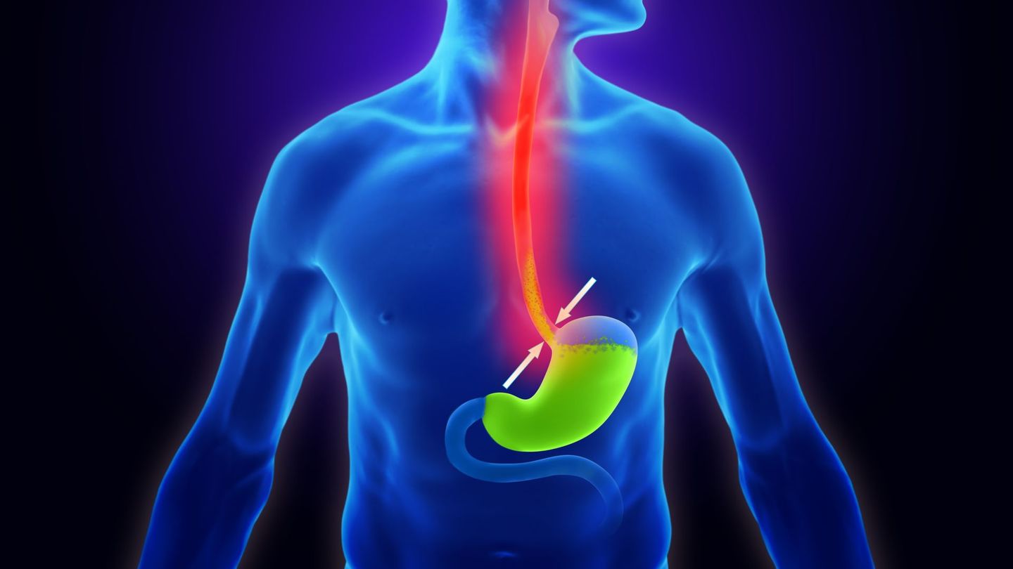 Normalerweise sorgt der Schließmuskel am unteren Ende der Speiseröhre dafür, dass die Magensäure nicht nach oben vordringt und Sodbrennen verursacht. Diese Verschlussfunktion kann jedoch aus verschiedenen Gründen eingeschränkt sein, sodass ein sogenannter Rückfluss (Lateinisch: Reflux) möglich ist. Auch ein zu voller Magen oder eine Überproduktion von Magensäure können zu Sodbrennen führen.