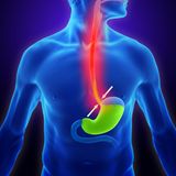 Normalerweise sorgt der Schließmuskel am unteren Ende der Speiseröhre dafür, dass die Magensäure nicht nach oben vordringt und Sodbrennen verursacht. Diese Verschlussfunktion kann jedoch aus verschiedenen Gründen eingeschränkt sein, sodass ein sogenannter Rückfluss (Lateinisch: Reflux) möglich ist. Auch ein zu voller Magen oder eine Überproduktion von Magensäure können zu Sodbrennen führen.