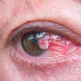 Foto eines Plattenepithelkarzinoms im Auge
