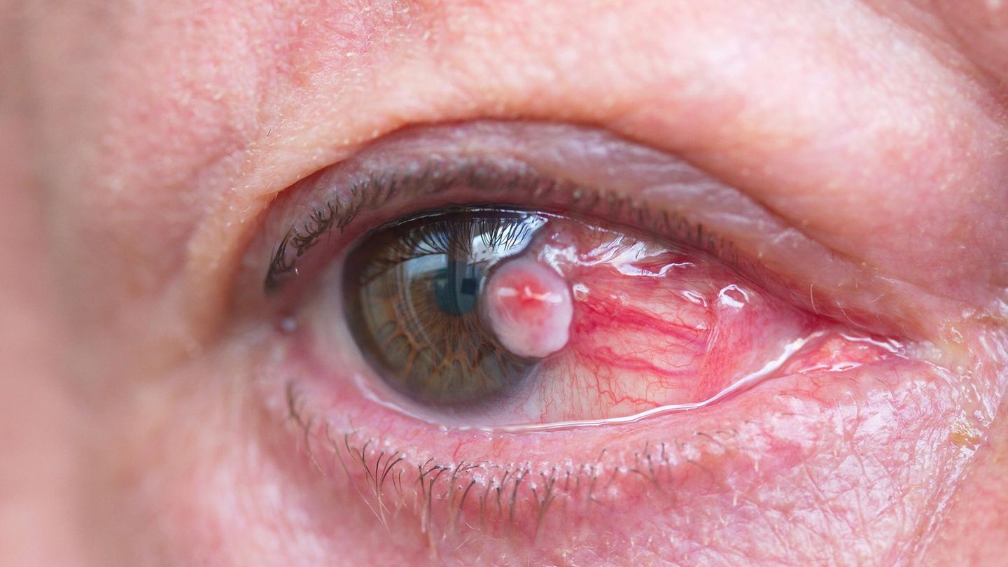 Foto eines Plattenepithelkarzinoms im Auge