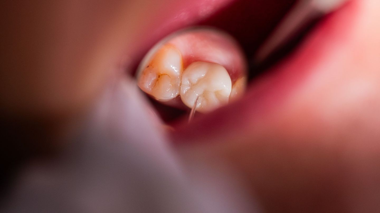 Vor allem auf dem Land fehlen in Mecklenburg-Vorpommern Zahnärztinnen und Zahnärzte. (Symbolbild) Foto: Rolf Vennenbernd/dpa/dpa