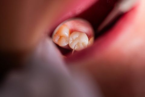 Vor allem auf dem Land fehlen in Mecklenburg-Vorpommern Zahnärztinnen und Zahnärzte. (Symbolbild) Foto: Rolf Vennenbernd/dpa/dpa