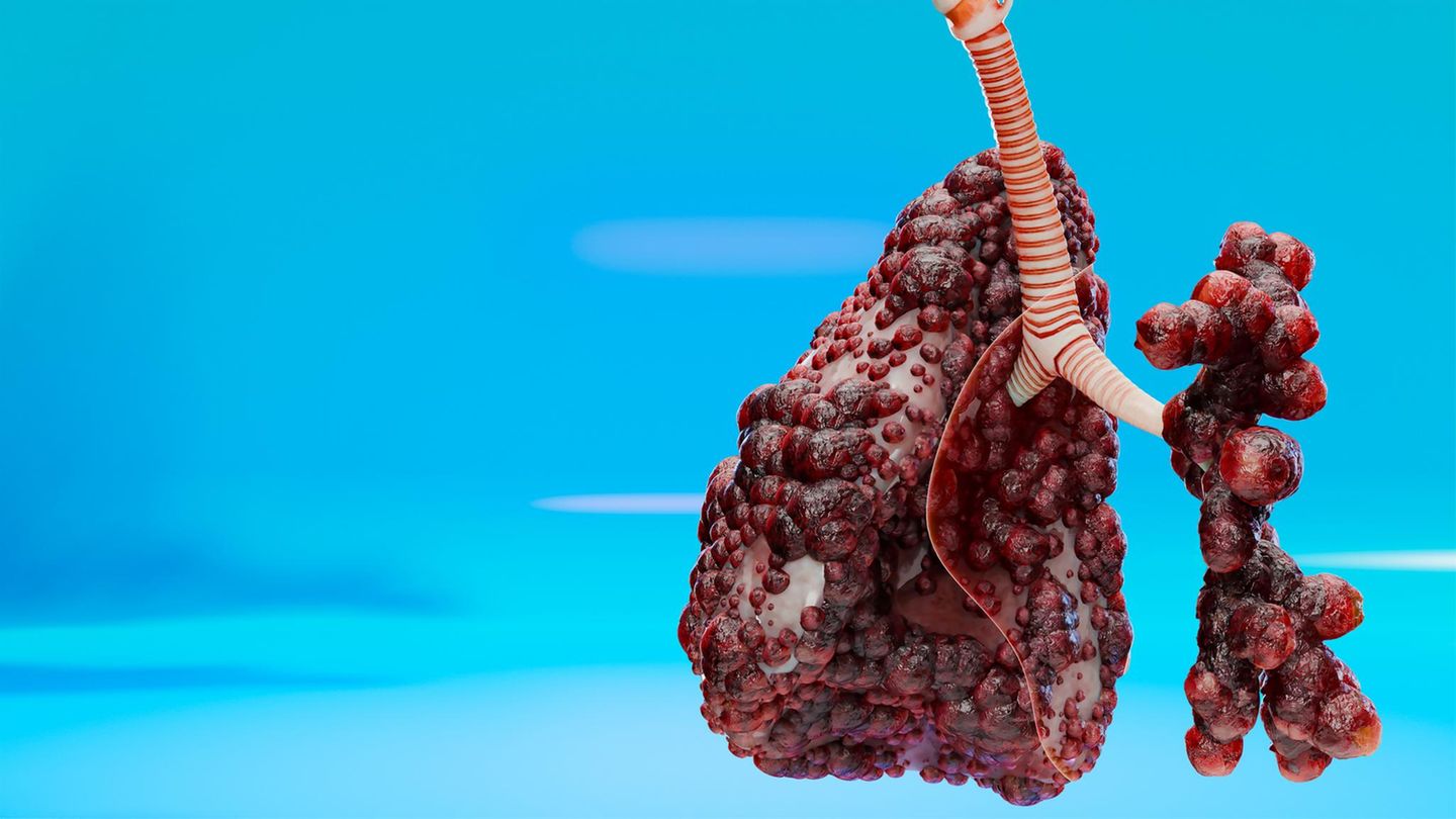 Eine §D Grafik eines Lungentumors