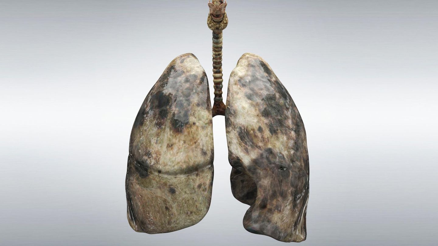 Bild der Lunge eines starken Rauchers