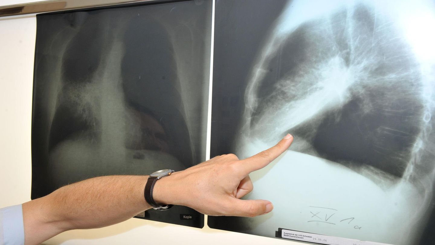 Ein Arzt zeigt auf ein Röntgenbild einer von Krebs befallenen Lunge