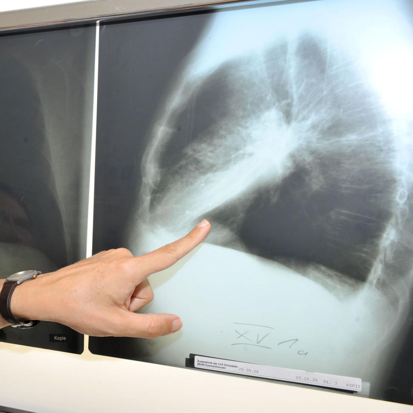 Ein Arzt zeigt auf ein Röntgenbild einer von Krebs befallenen Lunge