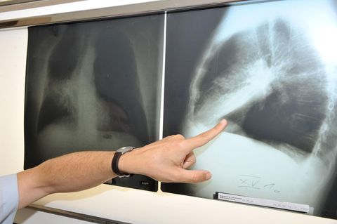 Ein Arzt zeigt auf ein Röntgenbild einer von Krebs befallenen Lunge