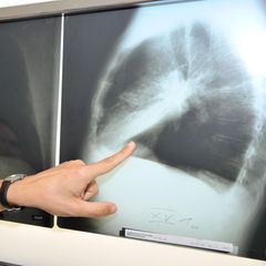 Ein Arzt zeigt auf ein Röntgenbild einer von Krebs befallenen Lunge