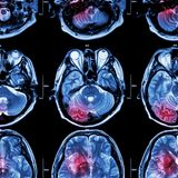 MRT Aufnahmen eins Kopfes mit Hrintumor