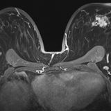 MRT Aufnahme einer Brust mit Brustkrebs