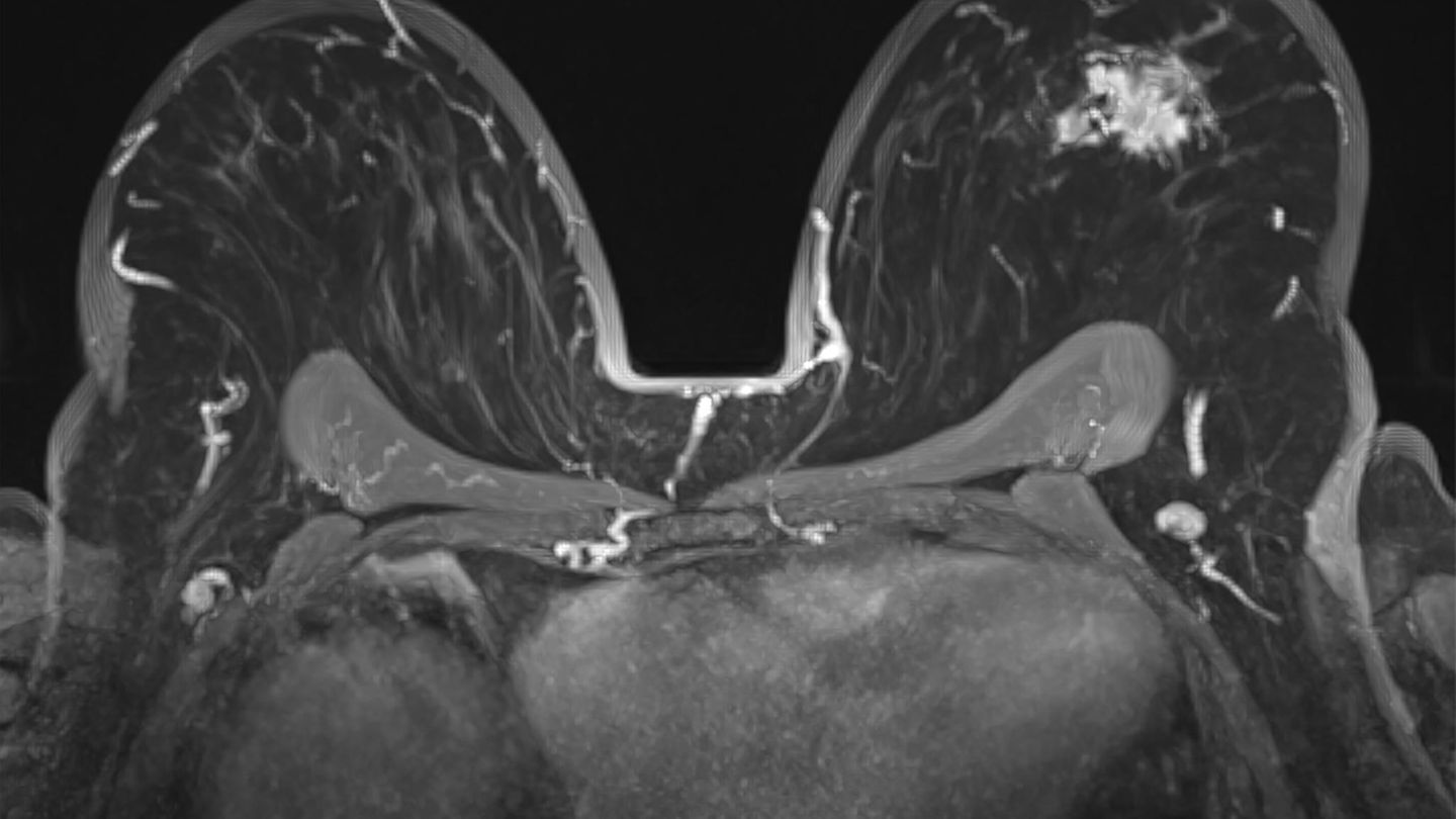 MRT Aufnahme einer Brust mit Brustkrebs