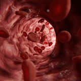 Wenn Blutgefäße entarten – das epitheloide Hämangioendotheliom  Das epitheloide Hämangioendotheliom ist ein rätselhafter Gefäßtumor, der Leber, Lunge oder Knochen betreffen kann. Lange bleibt er symptomlos, später treten Schmerzen oder Atemnot auf. Manche Verläufe sind harmlos, andere hochaggressiv. Seine Seltenheit erklärt sich durch die Stabilität der Ursprungszellen: Endothelzellen besitzen starke Reparaturmechanismen und teilen sich wenig. Nur sehr spezifische genetische Veränderungen können diese Schutzmechanismen überwinden – ein biologischer Zufall von extremer Unwahrscheinlichkeit.