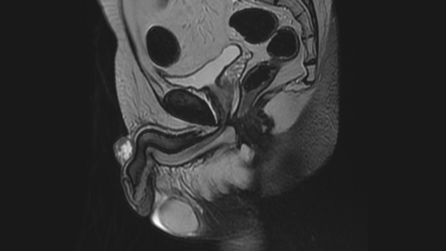 Röntgenaufnahme eines Penis mit Peniskrebs