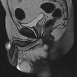 Röntgenaufnahme eines Penis mit Peniskrebs