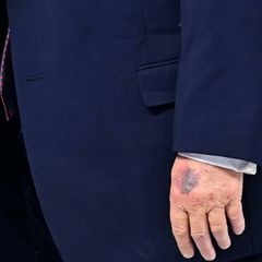 Bluterguss an der Hand von US-Präsident Trump in Davos