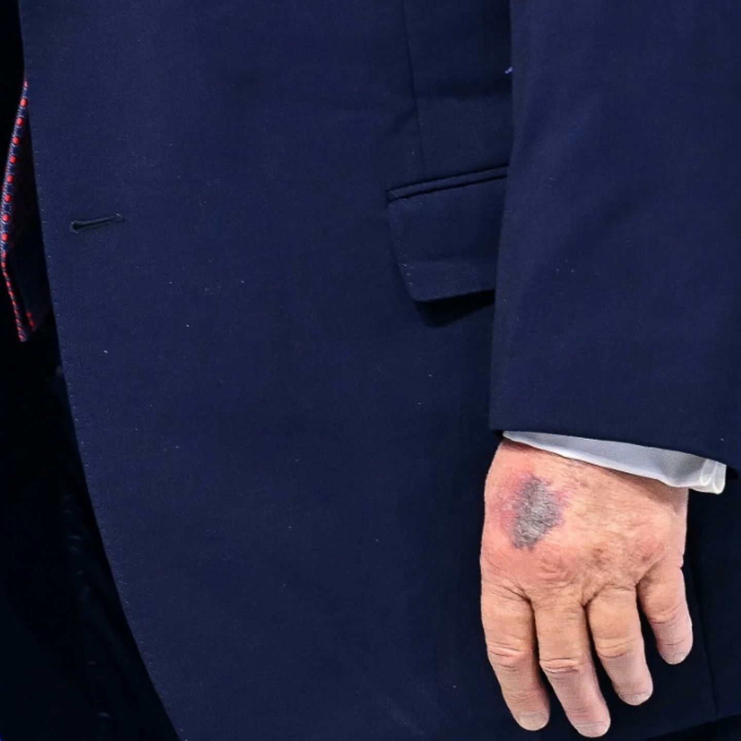 Bluterguss an der Hand von US-Präsident Trump in Davos