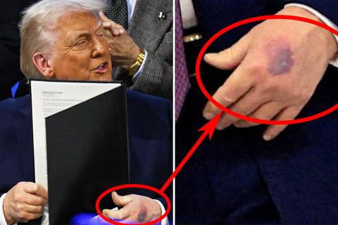 Dunkler Fleck an Trumps Hand löst Spekulationen aus-6973a55069772e250702cb62