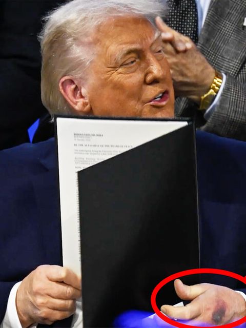 Dunkler Fleck an Trumps Hand löst Spekulationen aus-6973a55069772e250702cb62