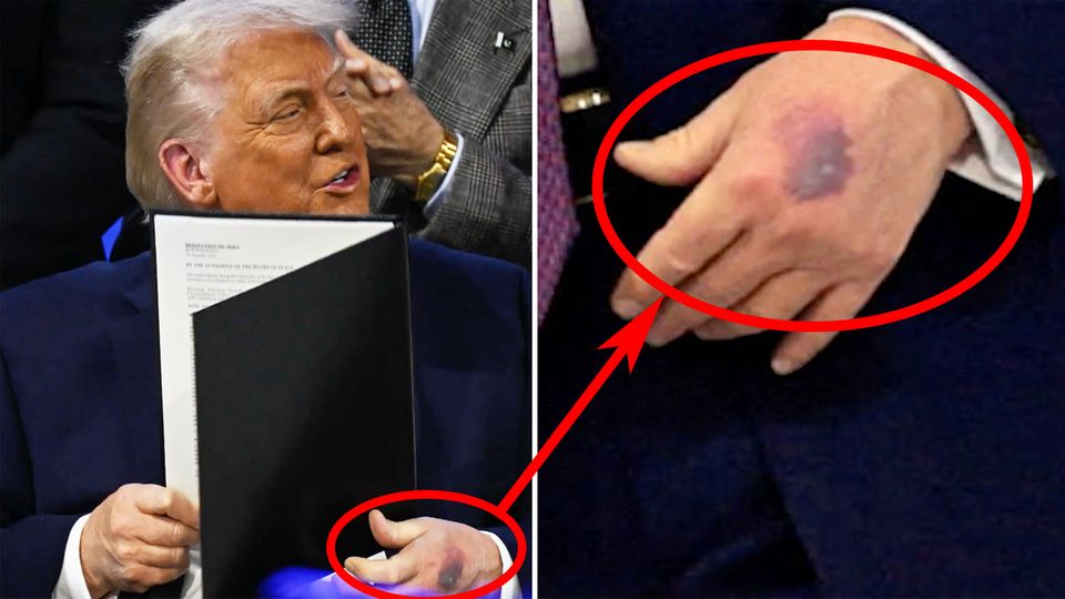 Dunkler Fleck an Trumps Hand löst Spekulationen aus-6973a55069772e250702cb62