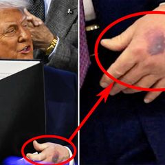 Dunkler Fleck an Trumps Hand löst Spekulationen aus-6973a55069772e250702cb62