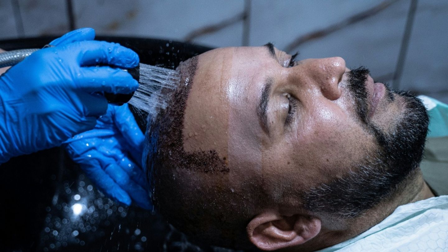 Kopfwäsche nach Haartransplantation