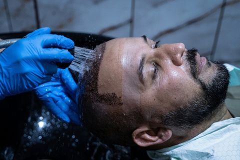 Kopfwäsche nach Haartransplantation