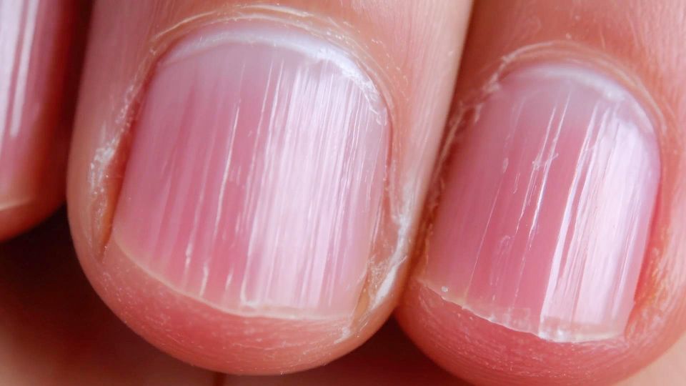 Flecken und Rillen: Welche Spuren auf Fingernägeln ein Warnsignal sein können