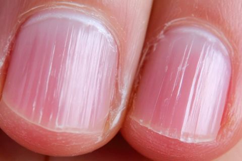 Flecken und Rillen: Welche Spuren auf Fingernägeln ein Warnsignal sein können