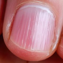 Flecken und Rillen: Welche Spuren auf Fingernägeln ein Warnsignal sein können