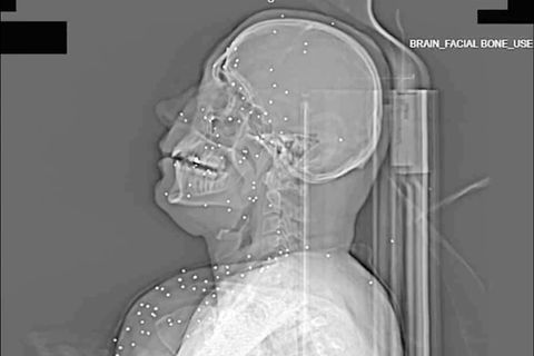 Ein Röntgenbild einer Person, die angeschossen wurde.