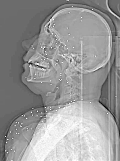 Ein Röntgenbild einer Person, die angeschossen wurde.