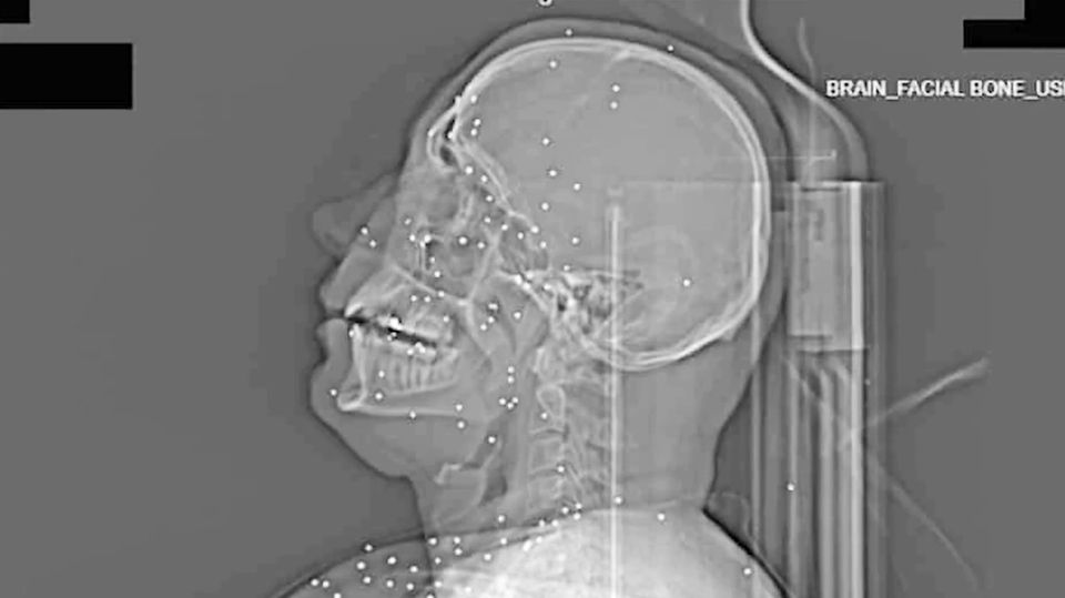 Ein Röntgenbild einer Person, die angeschossen wurde.